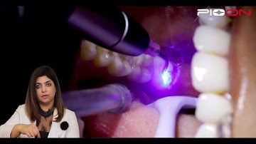 Excision of soft tissue Operculectomy by Pioon S1  Dental Diode Laser