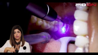 Excision of soft tissue Operculectomy by Pioon S1  Dental Diode Laser
