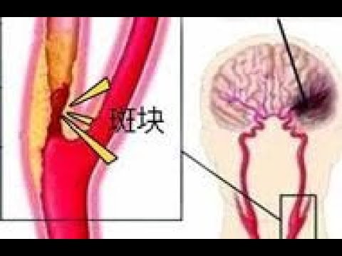 闢謠：發現頸動脈斑塊就得吃藥？醫生：這件事很重要！不僅吃藥