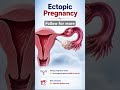 Ectopic Pregnancy Explained | Dangerous Pregnancy Complication #midwifery