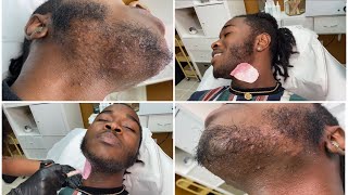 MALE CHIN WAX | INGROWN HAIR REMOVAL | Muva K Aesthetics