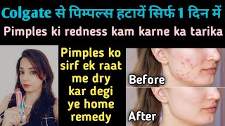 pimples kaise hataye 1 din me | pimples kaise hataye gharelu upay | how to remove pimples at home