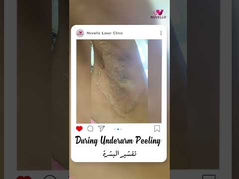 جربتي التقشير قبل كدا   