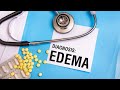 Edema Common Signs Symptom and Management