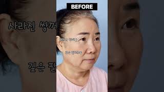 안면거상으로 팔자주름 + 불독살까지 개선! #shorts