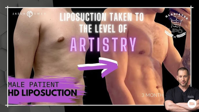 Liposuction Recovery Optimization Kit - POST OP RECOVERY