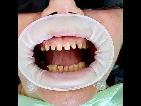 Коронки из Диоксид Циркония - примерка - YouTube