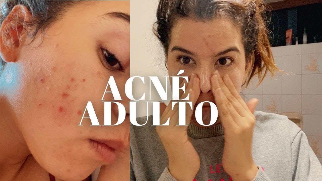 Acné a los 30s Mi Experiencia y Tratamiento YouTube