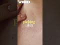 Hyperpigmentation  Dark Spots Explained