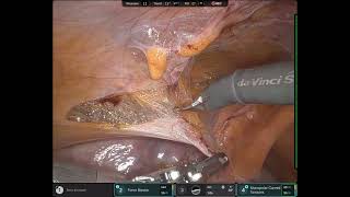 Full length unedited bilateral inguinal hernia repair using Intuitive DaVinci 5 Robot by Dr. Toomari