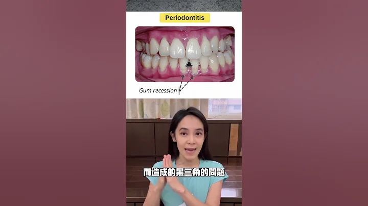 萎縮的牙齦可不可以長回去?黑三角可否自救＃牙齦萎縮 - 天天要聞
