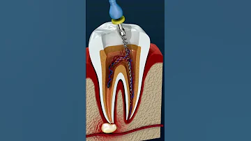 ¿Puede infectarse un diente sometido a una endodoncia?