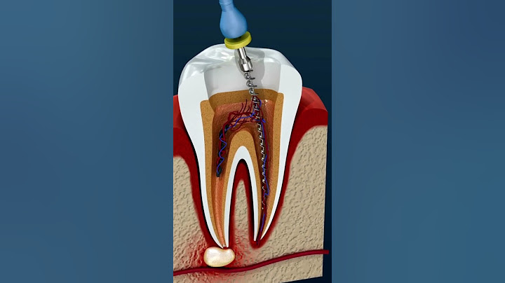 Una ENDODONCIA eficaz, supera la INFECCIÓN DENTAL