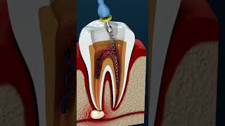 Una ENDODONCIA eficaz, supera la INFECCIÓN DENTAL