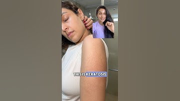 How did I treat my STRAWBERRY🍓SKIN/KERATOSIS PILARIS? #strawberryskin