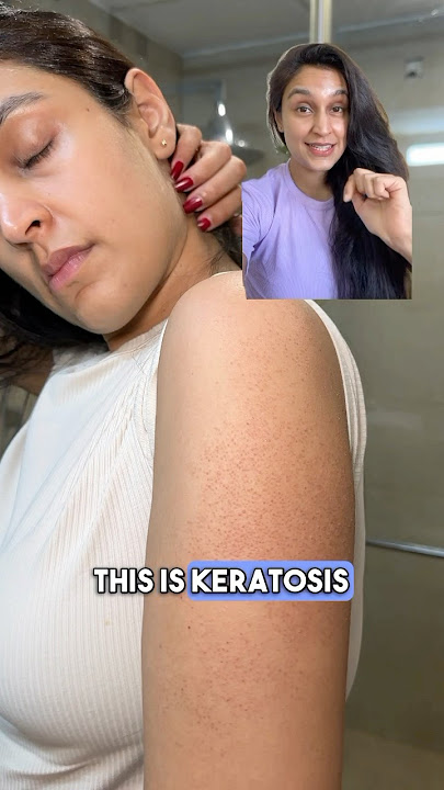 How did I treat my STRAWBERRY🍓SKIN/KERATOSIS PILARIS? #strawberryskin