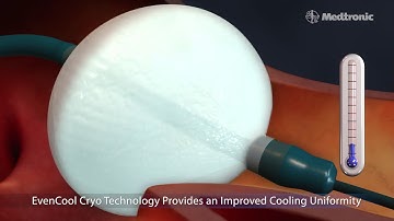 Công nghệ mới của Medtronic, điều trị rung nhĩ bằng CryoAblation Catheter system