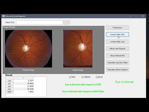 Automated Glaucoma Detection From Fundus Image Using Image Processing