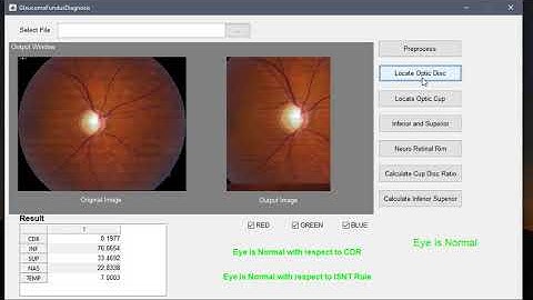 Automated Glaucoma Detection From Fundus Image Using Image Processing