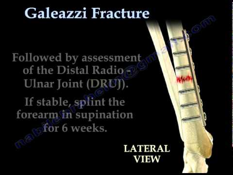 Galeazzi Fracture - Everything You Need To Know - Dr. Nabil Ebraheim