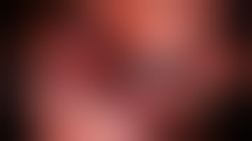 Totally Thoracoscopic Ablation of Atrial Fibrillation 1