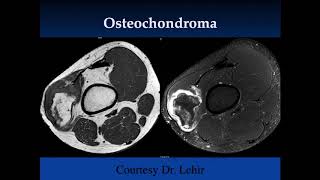 Bone Tumors Pt 1