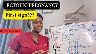 Signs and Symptoms of Ectopic Pregnancy// What causes Ectopic Pregnancy?