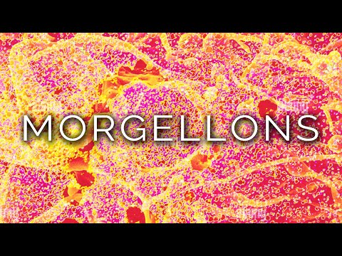 فيديو: كيفية التعرف على أعراض مورجيلونس: 13 خطوة (بالصور)
