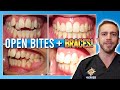 Open Bite Braces Treatment [BEFORE & AFTER!]