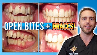 Open Bite Braces Treatment Before After