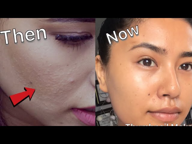 How To Get Rid Of Tiny Bumps On Face Clear Smooth Skin Secrets Beautynepal Youtube