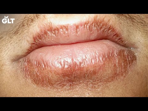 best-home-remedies-to-get-rid-of-chapped-lips