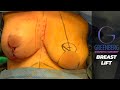 Breast Lift by Greenberg Cosmetic Surgery