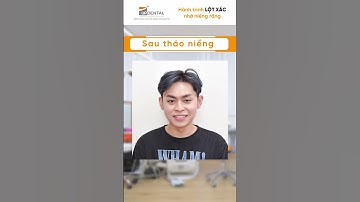 Hành trình LỘT XÁC nhờ niềng răng của Gia Huy