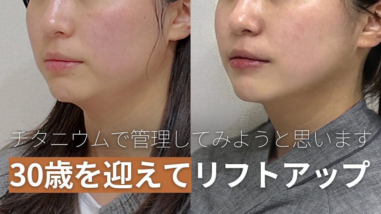 30歳を迎えてリフトアップ施術、チタニウムリフト🧡 - YouTube