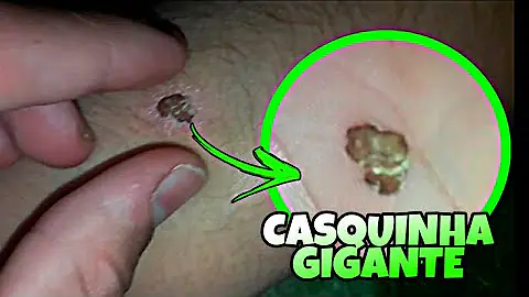 O que acontece se tirar a casca do machucado?