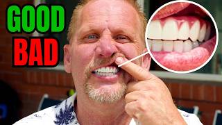 What I Hated About Getting Full Dental Implants