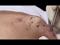 Popping huge blackheads and giant pimples  best pimple poppings 75