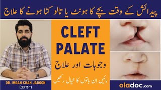 Cleft Lip And Palate Causes Treatment & Precautions - Cleft Lip Kyun Hota Hai - Cleft Palate Ka Ilaj