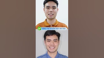 26 tuổi niềng răng Invisalign và cái kết