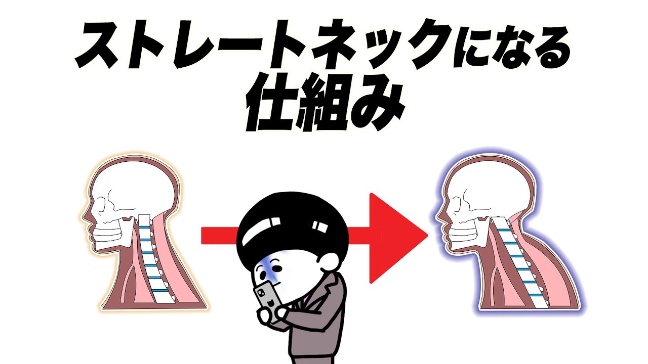 ストレートネック重症度チェック【アニメ】