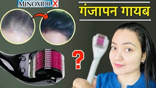 1 महीने में *Derma Roller* से बालों को REGROW करने का BEST तरीका जो कोई नहीं बताएगा | 100% Result❤️