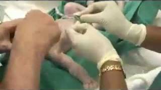 帝王切開 手術の動画 手術の動画 帝王切開 手術の動画 手術の動画