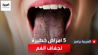 جفاف الفم من الأعراض الشائعة التي يجب الانتباه إليها والتي قد تقود لتشخيص 5 أمراض خطيرة