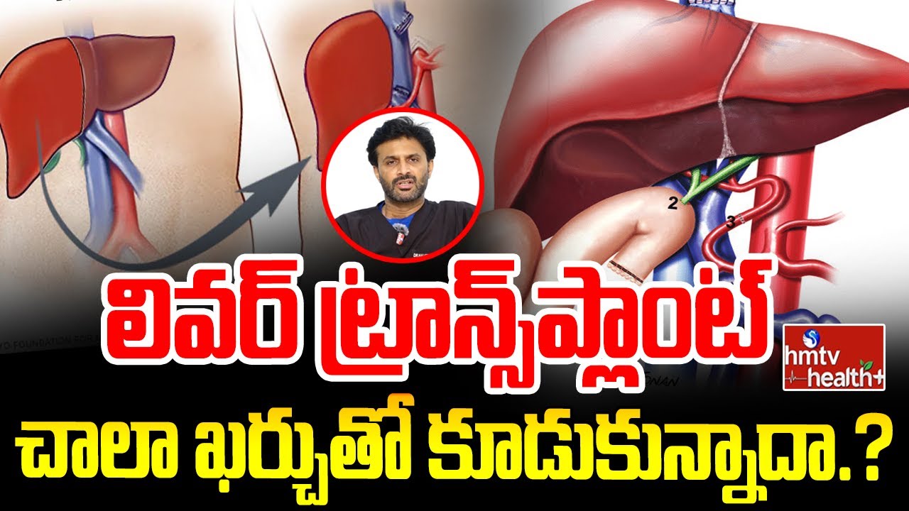 Liver Transplant : లివర్ ట్రాన్స్ప్లాంట్  చాలా ఖర్చుతో కూడుకున్నాదా.? | hmtv healthplus