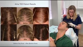 Alma Ted Hair Restoration Therapy - Needle Free Advanced, Ultrasound-Technology