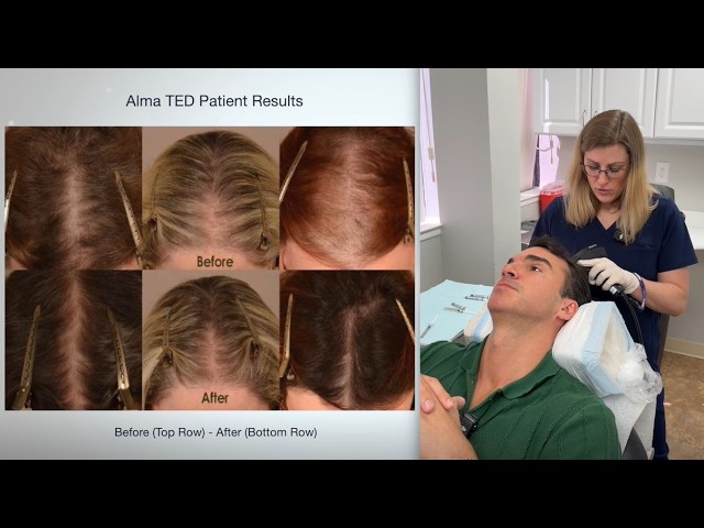Alma TED Hair Restoration Therapy - Needle Free Advanced, Ultrasound-Technology