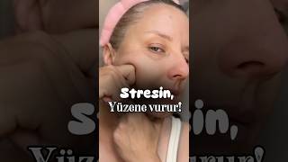 Meterçiğneme Kasın Spazmda Olunca Tüm Yüz Etkiliyor Ğalçözüm Üzyogası