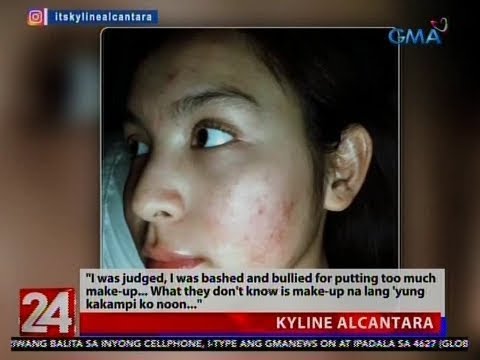 24 Oras: Kyline Alcantara, ikinuwento ang kanyang “acne breakout” experience