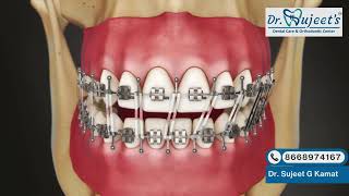 What is Intermaxillary Fixation (IMF) | Uses, Procedure & Recovery Explained